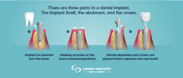 Dental Implants Graphic 