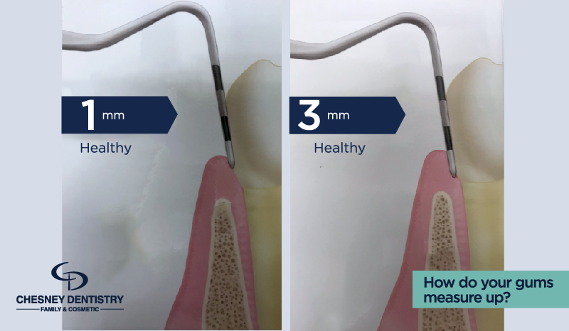 Healthy Dental Probing